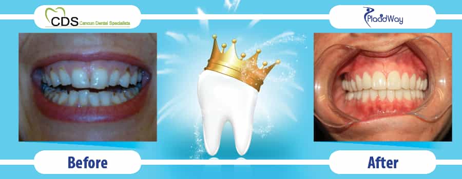 Patient Result Dental Implants in Cancun Mexico at Cancun Dental Specialists Patient Result Dental Implants in Cancun Mexico at Cancun Dental Specialists